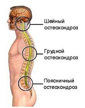 шейный, грудной или поясничный остеохондроз